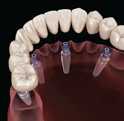 Implantology Near Me